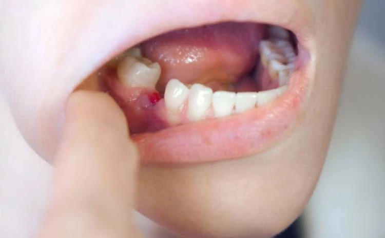 خراج اللثة بعد خلع الضرس 1 أعراض خلع اللثة بعد خلع الضرس