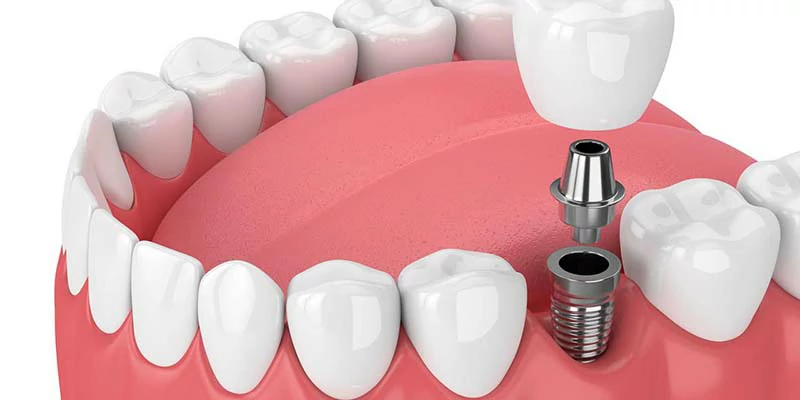 انواع زراعة الاسنان | أفضل أنواع زراعات الأسنان وأسعارها 2 انواع زراعة الاسنان وأفضلها