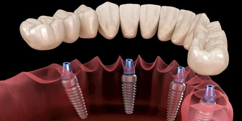 انواع زراعة الاسنان | أفضل أنواع زراعات الأسنان وأسعارها 1 أنواع زرعات الأسنان السويسرية
