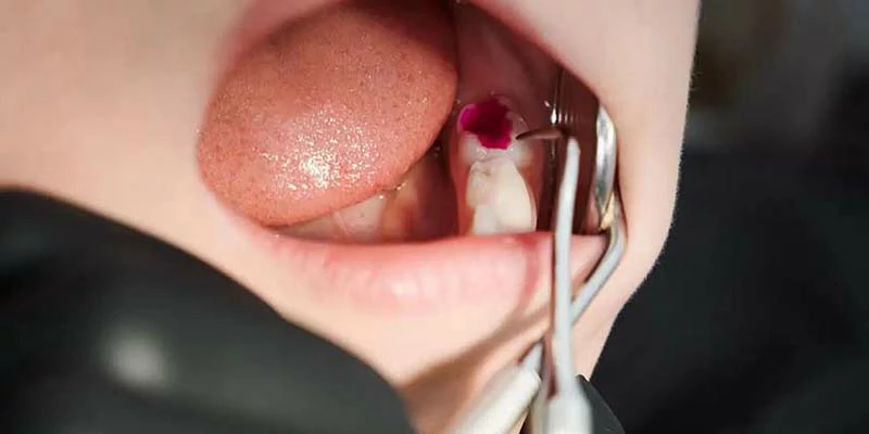 ما هي اسباب خراج الاسنان؟ 2 اسباب خراج الاسنان وعلاجه