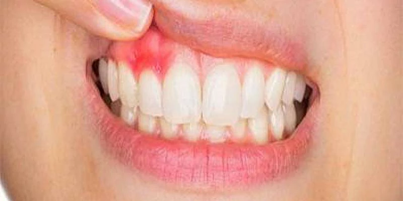 ما هي اسباب خراج الاسنان؟ 1 اسباب خراج الاسنان