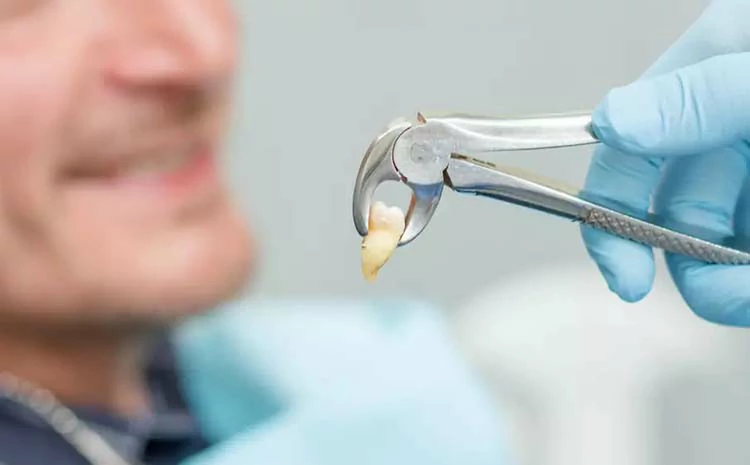 هل يمكن خلع الضرس مع وجود خراج؟ 2 بدائل أخرى لعلاج الضرس المتأذي بالخراج