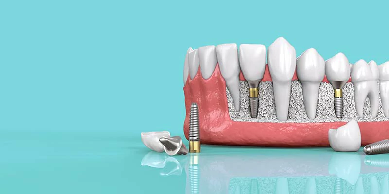 هل يمكن زراعة الاسنان لمرضى السكر؟ 1 مرض السكر وتأثيره على الأسنان