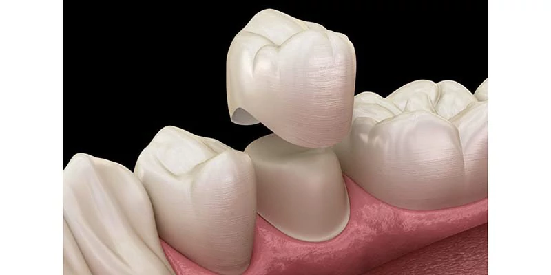 طربوش الاسنان الزيركون | المميزات والفوائد 2 سعر طربوش الأسنان الزيركون