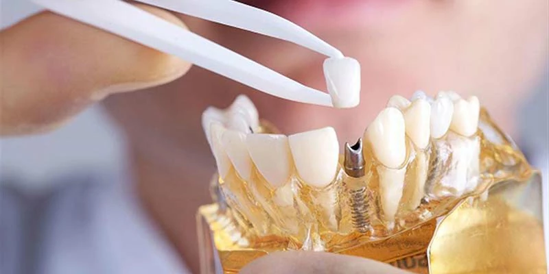 اسباب فشل زراعة الاسنان 2 نصائح تجنب فشل زراعة الأسنان