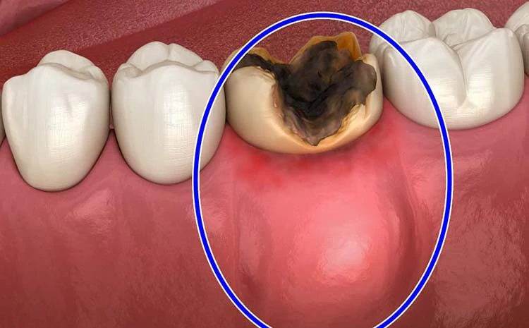 هل يمكن خلع الضرس مع وجود خراج؟ 1 علامات عدوى خلع الضرس مع وجود خراج
