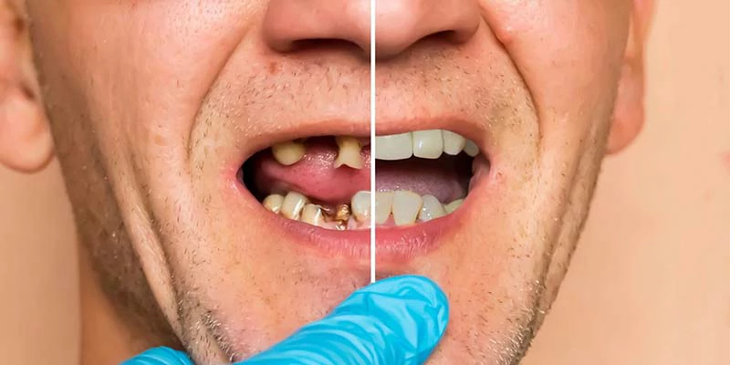 اسباب فشل زراعة الاسنان 1 اسباب فشل زراعة الاسنان المتأخر