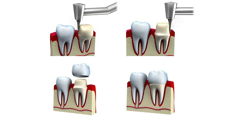 هل طربوش الاسنان يسوس؟ 2 ما هو أفضل طربوش أسنان؟