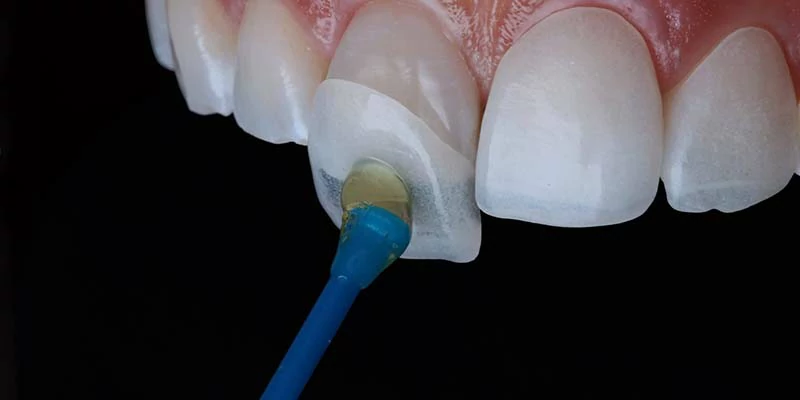 أضرار زراعة الاسنان | هل أضرار زراعة الاسنان تفوق فوائده؟ 2 علاج أضرار زراعة الاسنان