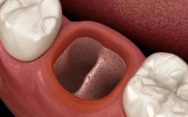 خراج اللثة بعد خلع الضرس 2 مدة شفاء الخراج بعد خلع الضرس