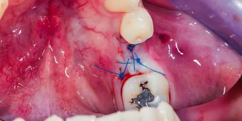 اعراض خراج الضرس | الاسباب والعلاج 2 مضاعفات خراج الضرس