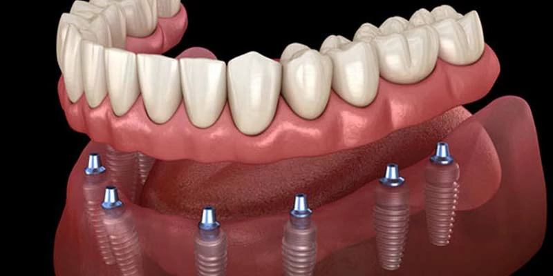 زراعة الاسنان الفورية | مميزات وعيوب زراعة الاسنان 1 الفرق بين زراعة الأسنان الفورية والتقليدية